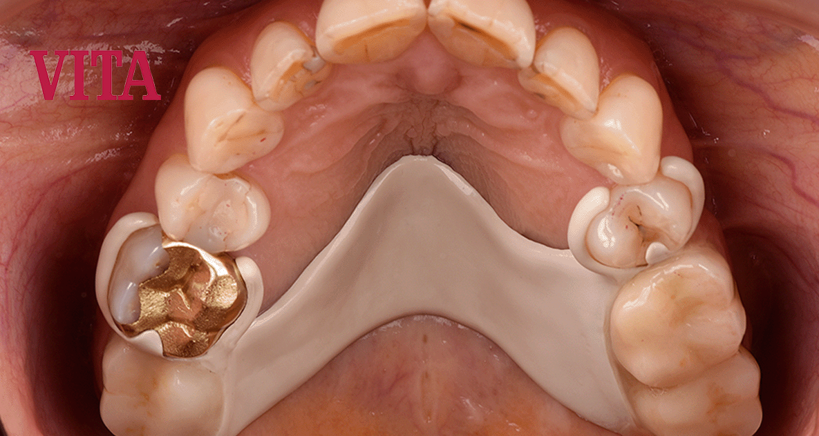 Precision-fit premium teeth using VITA VIONIC® DENT DISC multiColor